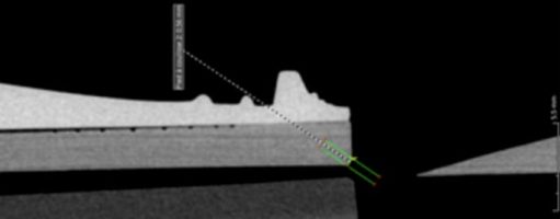 Figure 6 : La profondeur du chanfrein supérieur, à la sortie du canal (assez inaccessible)
